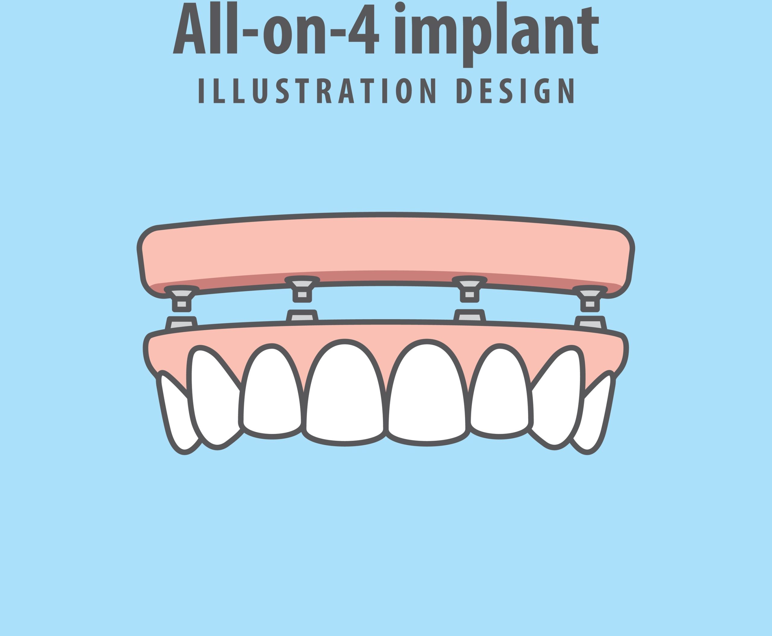 Why choose All-on-4 implants?