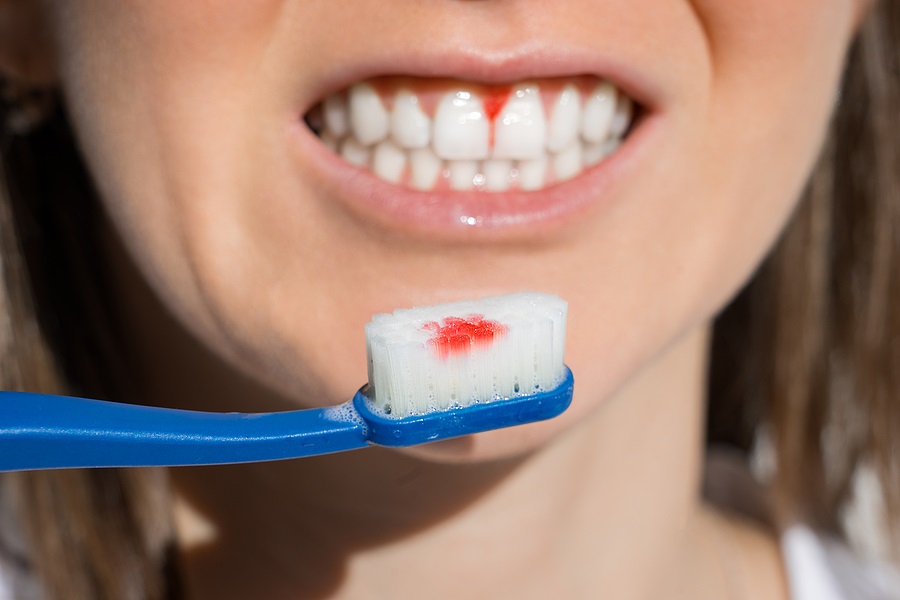 What Is Gingivitis?