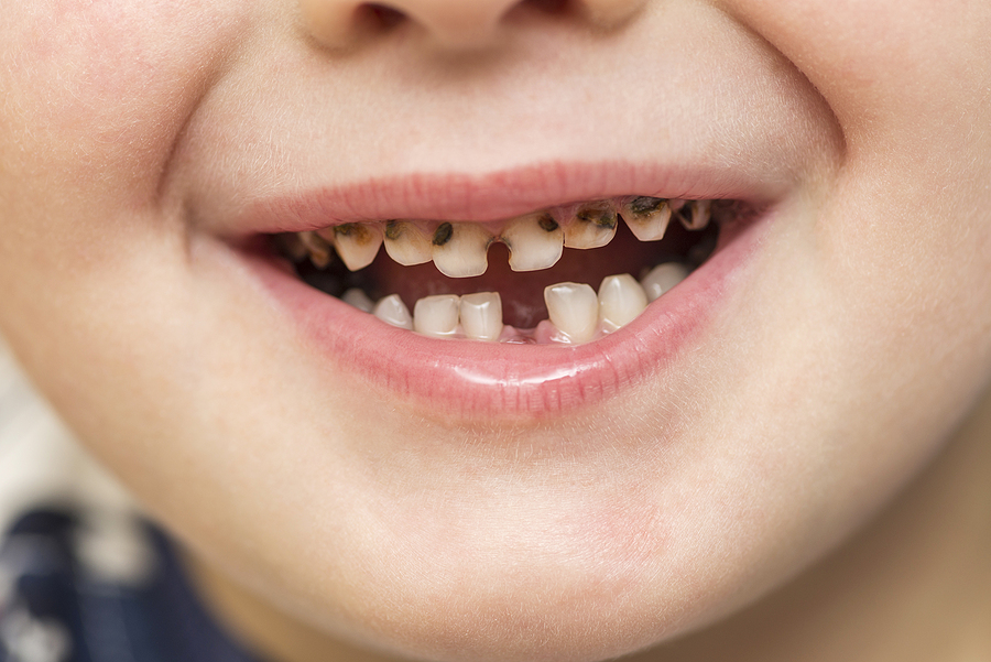 Different Materials Used for Dental Fillings