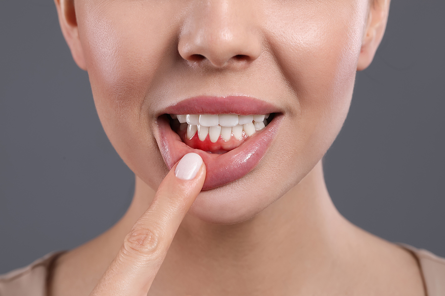 Risk Factors for Gum Disease