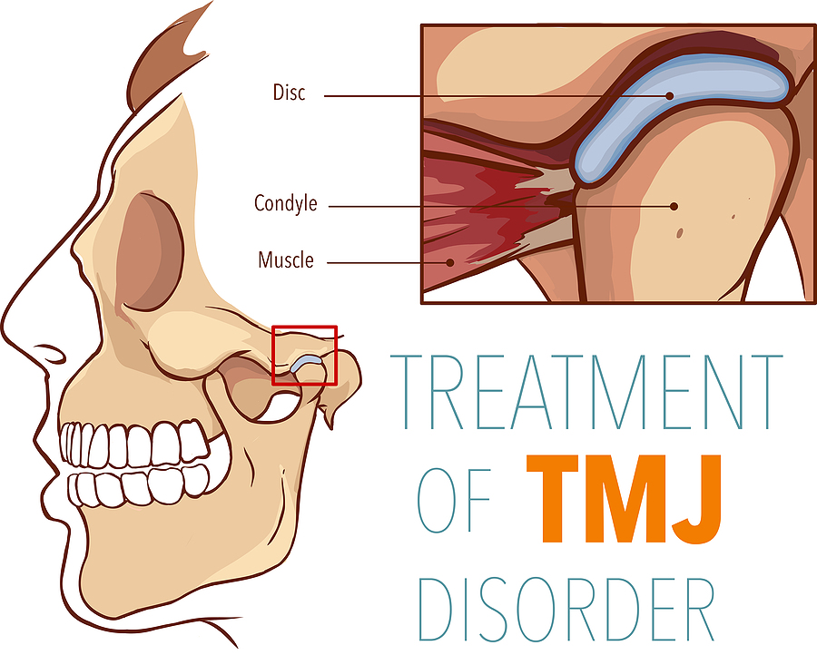 Alleviating Jaw Pain with Effective TMJ Treatment in Chicago, IL